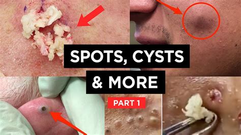 1 ene 2023. . New cystic acne popping videos youtube
